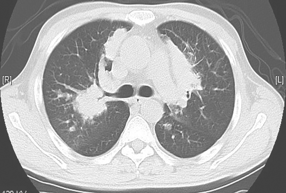 图5 韦格纳肉芽肿病胸部CT表现-1b122fbf751e437286da9c9076853e44.jpg